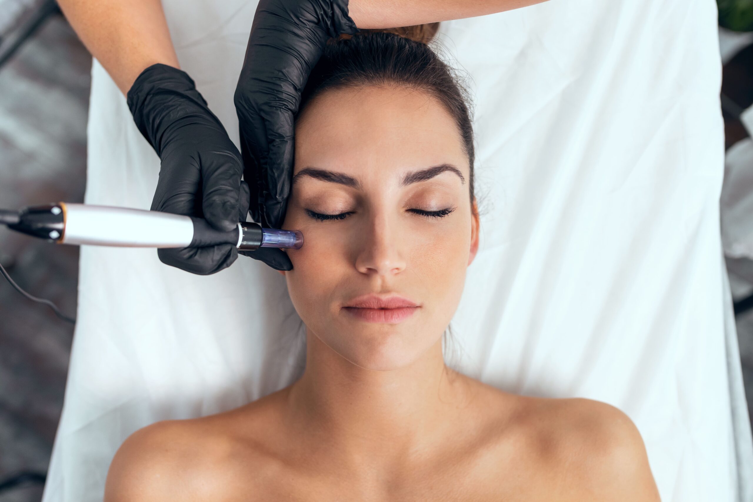 foto-servicios-microneedling-estetica-y-belleza-raquel